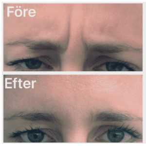 Botox före och efter behandling