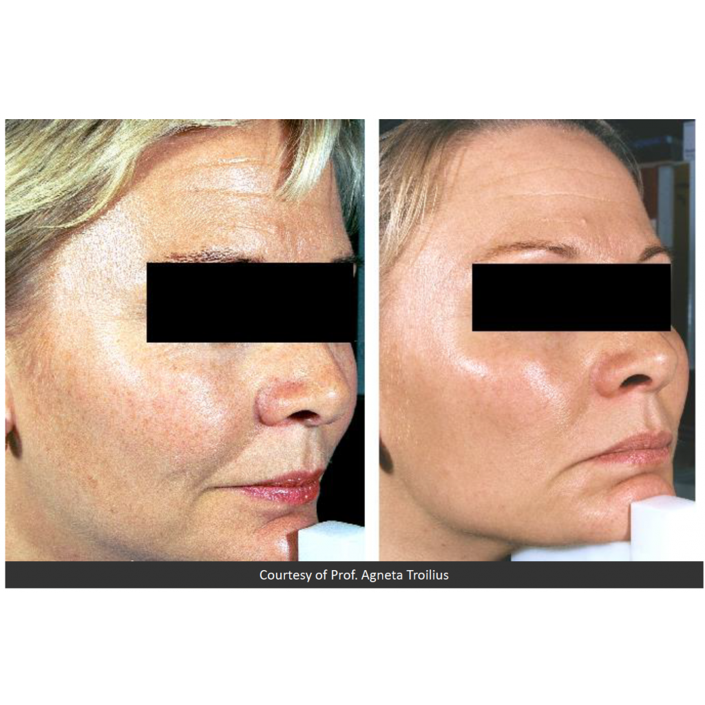 Före och efter behandling av solskadad hud