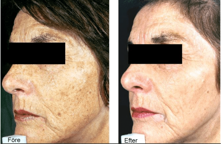 Före och efter behandling av solskadad hud
