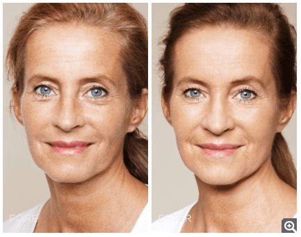 Skinbooster behandling - före och efter behandling