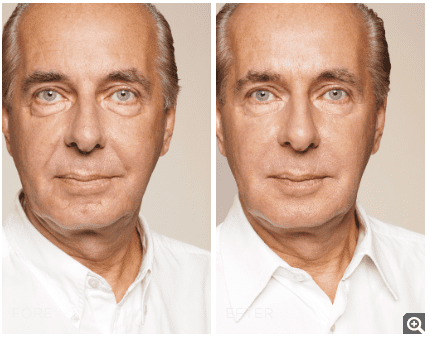 Skinbooster behandling - före och efter behandling