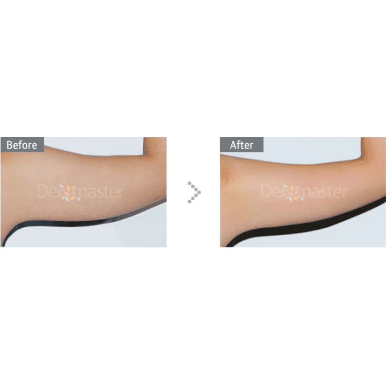Ultra V Trådlyft behandling av armar