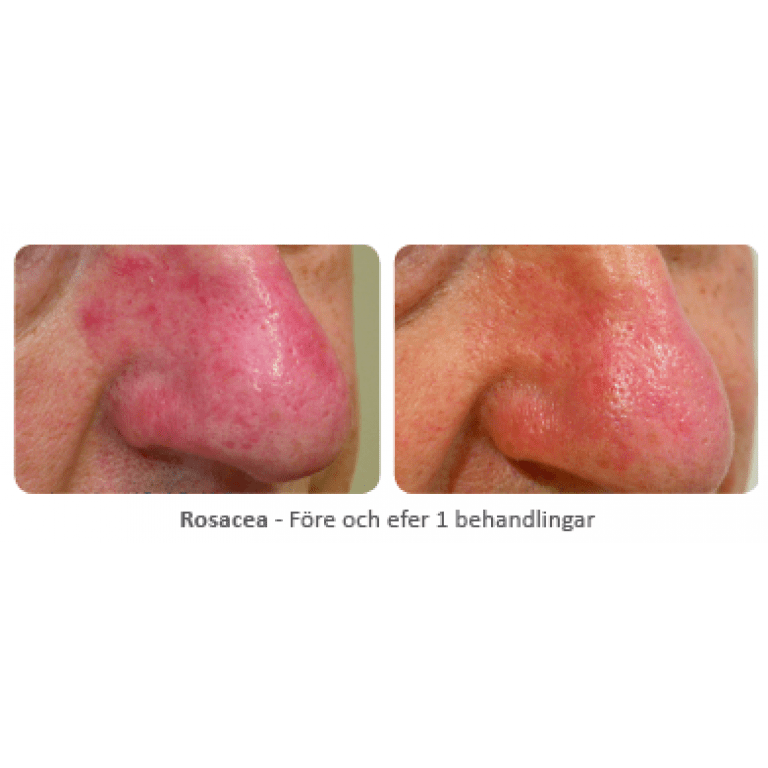 Före och efter behandling av rosacea