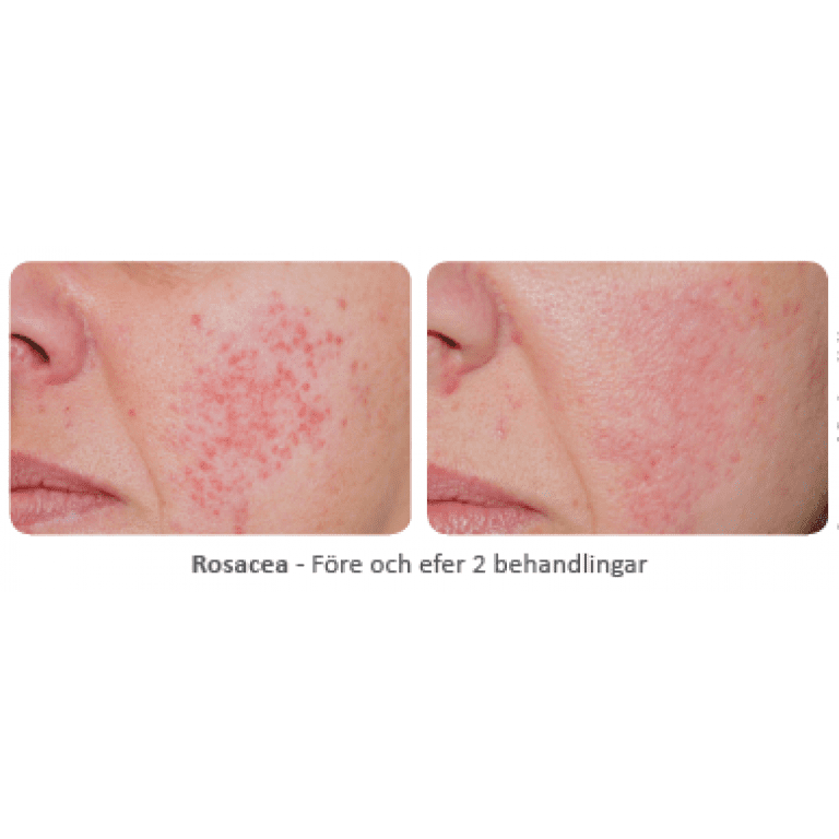 Före och efter behandling av rosacea