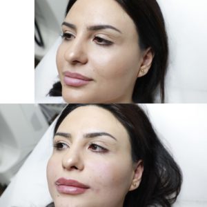 Filler-Complete-Skin-hudläkare-estetiska-behandlingar-stockholm