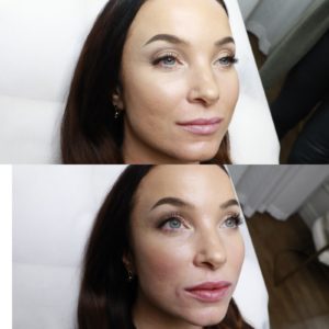 Filler-Complete-Skin-hudläkare-estetiska-behandlingar-stockholm