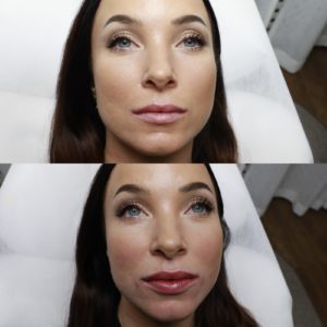 Filler-Complete-Skin-hudläkare-estetiska-behandlingar-stockholm