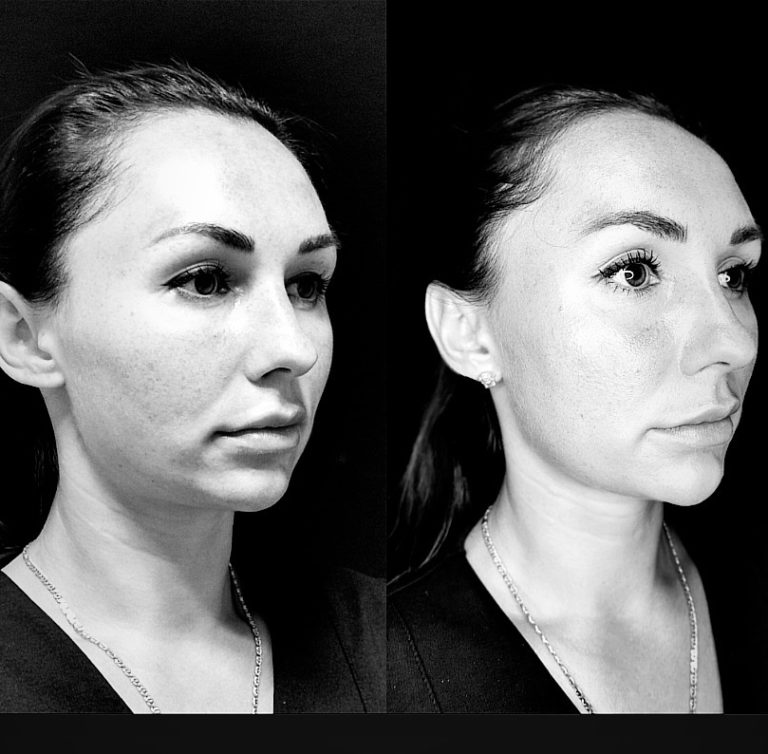 Resultat Trådlyft: mellan/ nedre delen av ansiktet