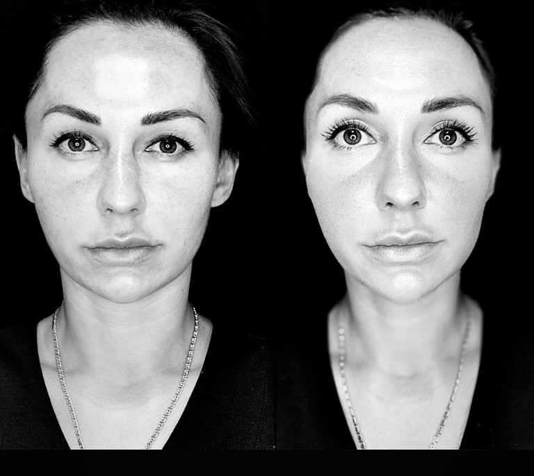Resultat Resultat Trådlyft: mellan/ nedre delen av ansiktet : mellan/ nedre del en av ansiktet